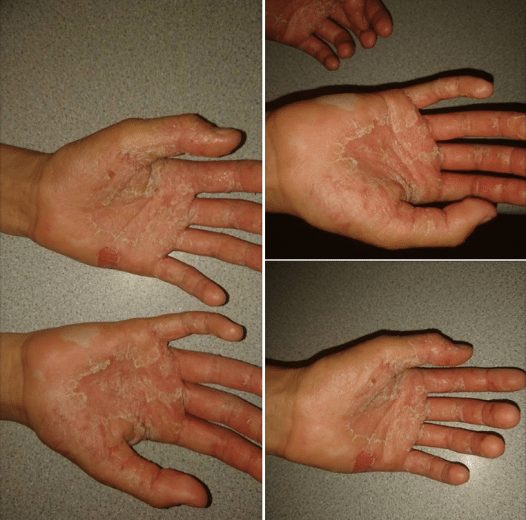 Breaking Parents Warning After Little Girl Gets Chemical Burns From Slime