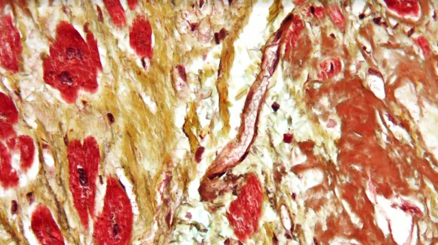 Nanoparticle Breakthrough Offers New Hope for Skin and Lung Fibrosis Sufferers